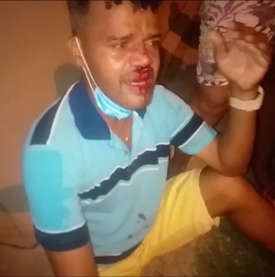 Bibi ficou ferido no rosto.